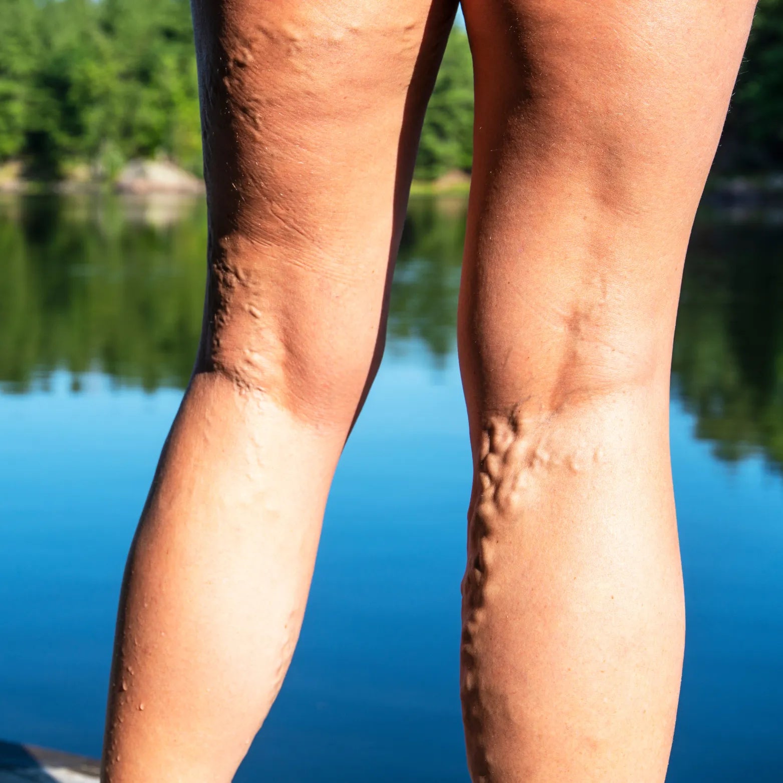 Varicose Vein on leg